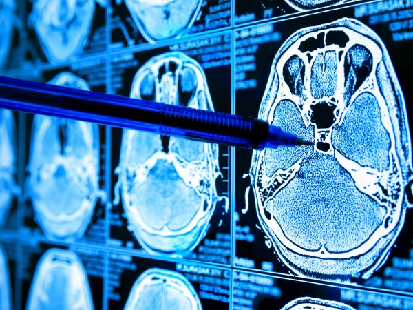 Artificial intelligence kunstmatige intelligentie zorg health brains hersenen